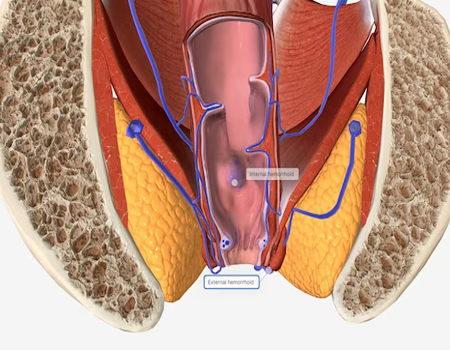 fistula