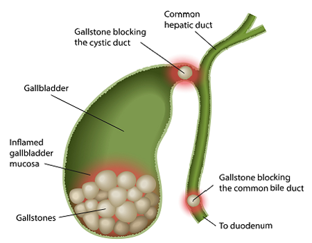 galbladder